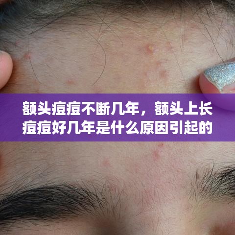 额头痘痘不断几年,额头上长痘痘好几年是什么原因引起的