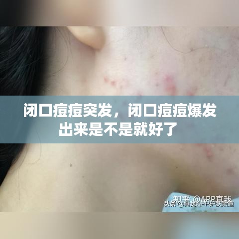 闭口痘痘突发，闭口痘痘爆发出来是不是就好了 
