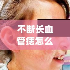 不断长血管痣怎么办？了解、应对与预防全攻略！