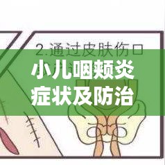 小儿咽颊炎症状及防治，百度权威解答！