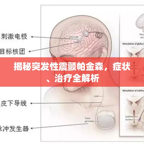 揭秘突发性震颤帕金森，症状、治疗全解析