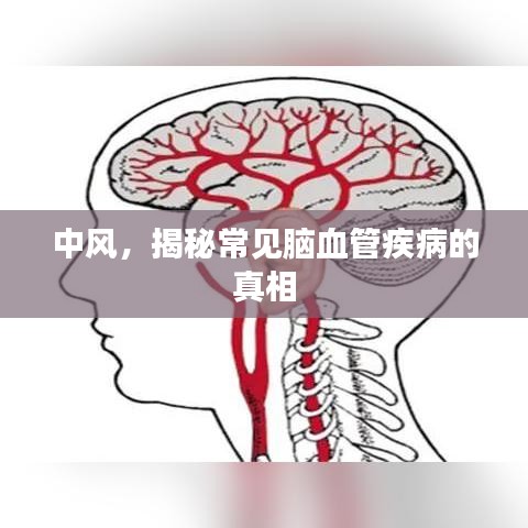 中风，揭秘常见脑血管疾病的真相